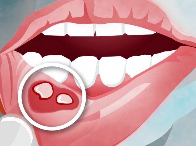 Причины ретенционной кисты нижней губы